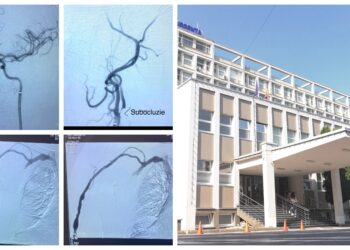 Primul caz de accident vascular cerebral ischemic acut trimis de la SJU Botoșani, tratat cu succes la Spitalul Județean Suceava