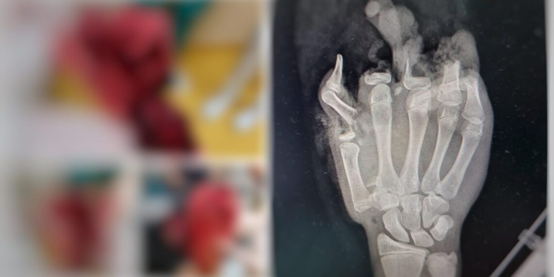 Mutilat pe viață de o petardă. Un adolescent de 14 ani a ajuns cu mâna dreaptă ciopârțită la SJU Suceava