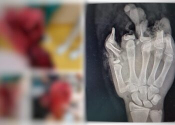 Mutilat pe viață de o petardă. Un adolescent de 14 ani a ajuns cu mâna dreaptă ciopârțită la SJU Suceava