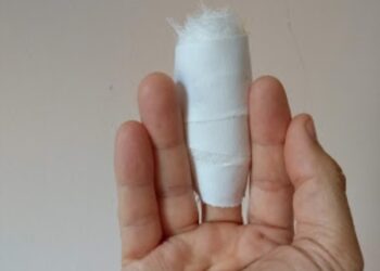 Bărbat ajuns la spital, după ce și-a dat cu toporul peste degetul mijlociu al mâinii stângi