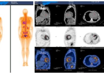 O nouă investigație modernă este accesibilă în SJU Suceava. Scintigrafia cu difosfonați, metoda pentru diagnosticul amiloidozei ereditare