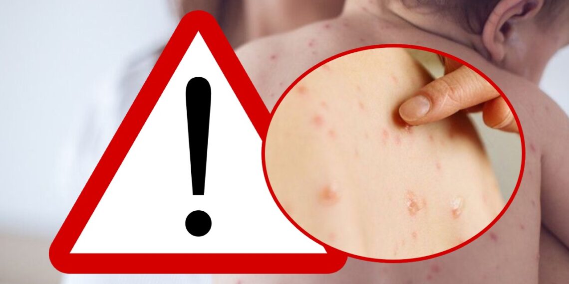 Focar de rujeolă în satul Bogata, din comuna Baia: ”În UAT Baia, în cele 3 luni de la declararea epidemiei, au fost vaccinați doar 9 copii, rămânând în jur de 70 de copii restanțieri cu una sau două doze”