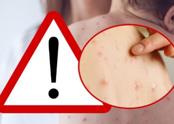 Focar de rujeolă în satul Bogata, din comuna Baia: ”În UAT Baia, în cele 3 luni de la declararea epidemiei, au fost vaccinați doar 9 copii, rămânând în jur de 70 de copii restanțieri cu una sau două doze”