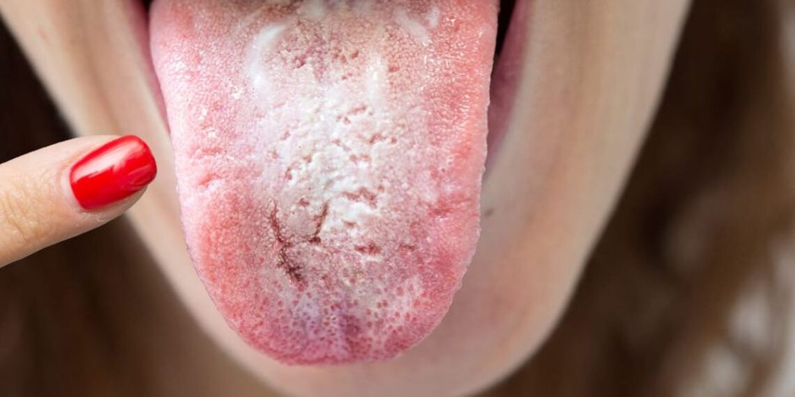 Cele mai contagioase infectii ale cavitatii bucale