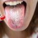 Cele mai contagioase infectii ale cavitatii bucale