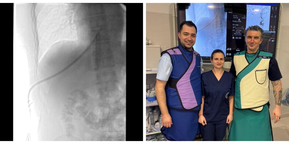 O echipă de abord vascular a realizat în premieră regională procedura de inserție de cateter permanent pentru hemodiliză prin abord transhepatic: ”SCJU Suceava a încheiat anul cu o provocare deosebită și o reușită remarcabilă”